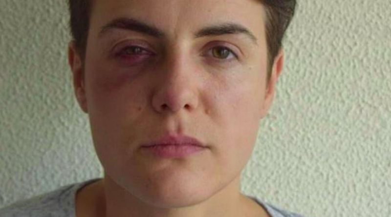 Napadnuta pripadnica Oružanih snaga BiH: Nije problem ozljeda, nego ponašanje policajaca