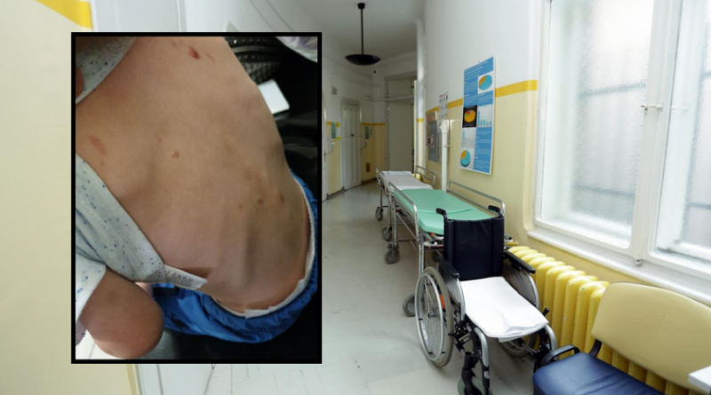 U zagrebačku bolnicu doveli dječaka s lomovima i ožiljcima od čikova