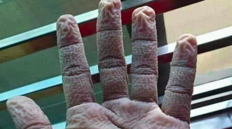 Goran Čerkez fotografijom ruke medicinske sestre poslao snažnu poruku građanima